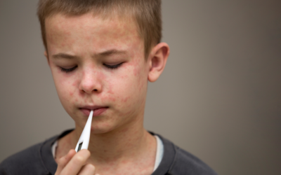 What Signs to Look Out for During Measles Outbreak