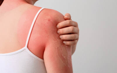 When to Go to the ER for a Sunburn